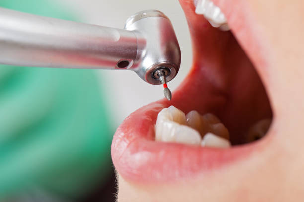 Best Emergency Dental Extractions in Moore, OK